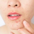 What Is Perioral Dermatitis? 2 Dermatologists Explain